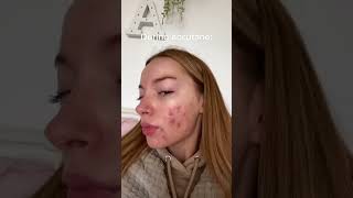 This is WHY you MUST try ACCUTANE🙀💯💁🏻‍♀️ #shorts #acne #transformation #healing #acnetreatment