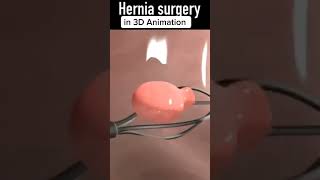 Hernia Surgery|| Hernia Surgery in 3D Animation #shorts #youtubeshorts #viral