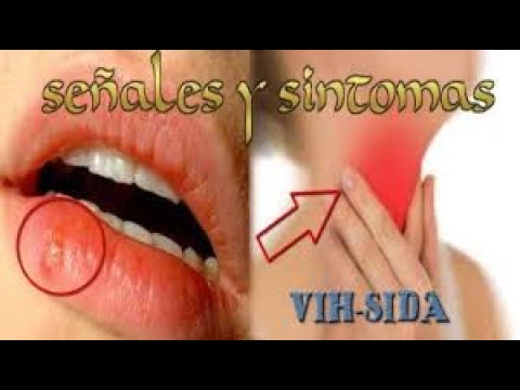 ¿Cuáles son los síntomas del VIH/SIDA?