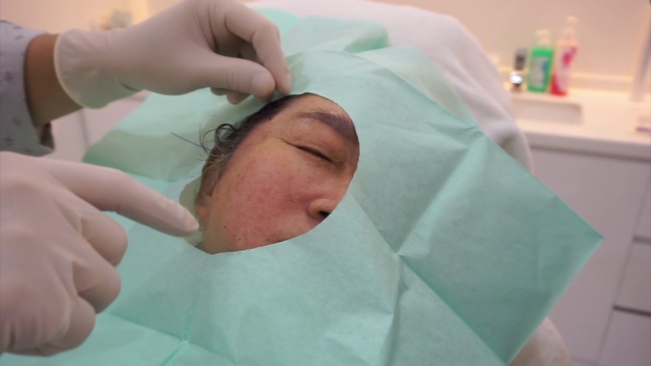 PDO Korean NonSurgical Thread Lift of the Face See How Its Done