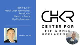 Technique Of Metal Liner Removal For Revision Of Metal On Metal Hip Replacement