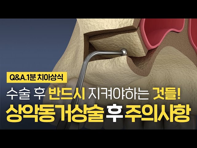 상악동거상술 수술 후 이것 모르면 실패한다고?! 상악동임플란트 주의사항 ⏰1분 치아상식