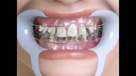 Video Clip mô tả ngắn gọn quá trình niềng răng mắc cài sứ