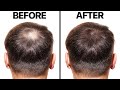 Minoxidil for Hair Loss