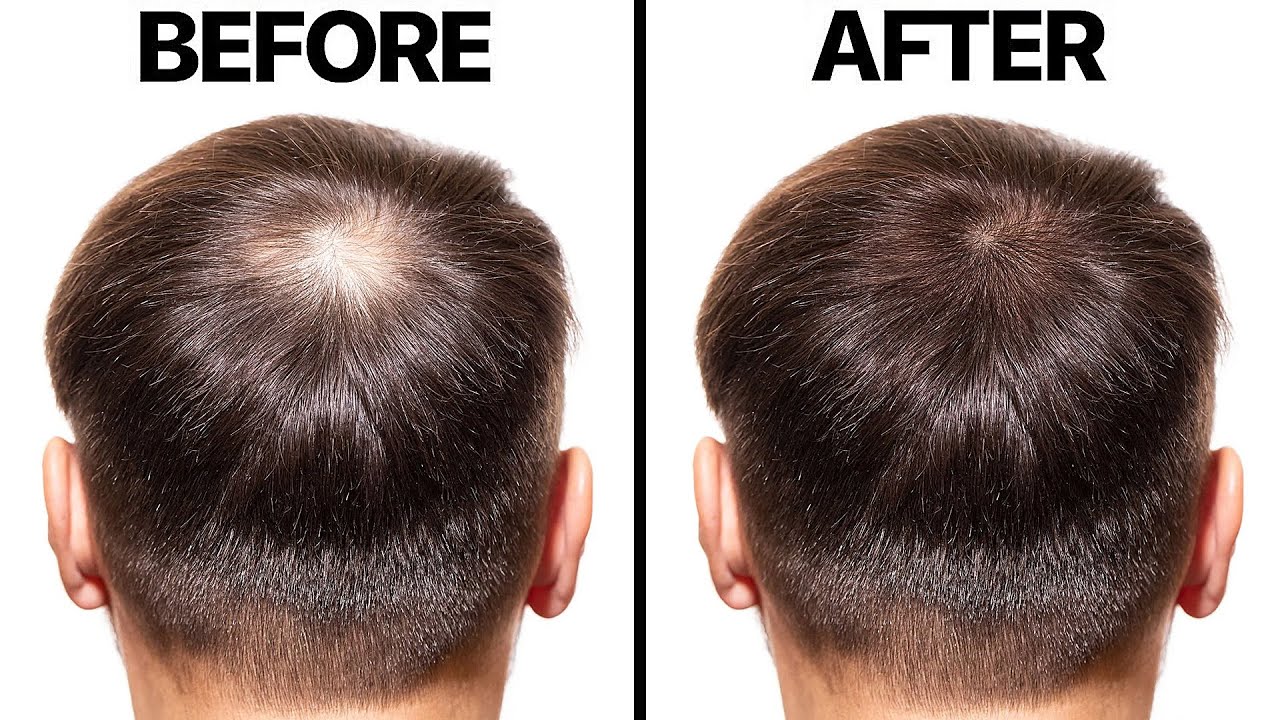 Mens Rogaine 5 Minoxidil Foam for Hair Loss and India  Ubuy