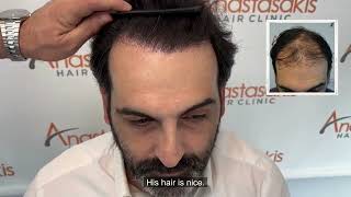 Incredible Hair Transformation - Stage 5 Hair Loss to Full Hair after FUE Hair Transplant ?