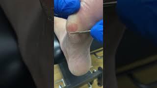 Thick Dry Forefoot Callus Cutting By Podiatrist So satisfying to watch