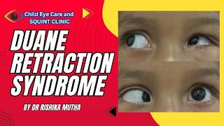 Squint surgery in india | Best squint treatment in india | Duane retraction syndrome