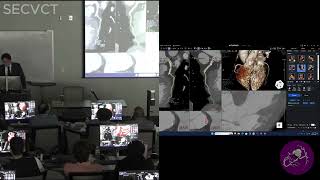 Continued Case Analysis with Dr. Bruno Lima (Part 6 of 8) | SECVCT