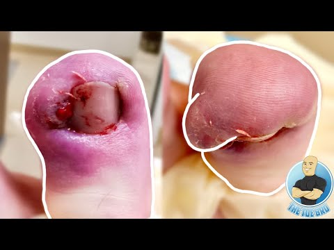 SHE FILMED HER INGROWN SURGERY FROM THE HOSPITAL AND SHOWED ME ***GRAPHIC VIDEO***