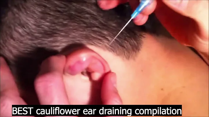 BEST cauliflower ear draining compilation