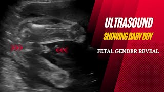 Ultrasound Showing Baby Boy - Fetal Gender Reveal