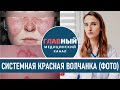 Как выглядит Красная Волчанка (фото 1-9). Симптомы системной красной волчанки. Болезнь Либмана-Сакса