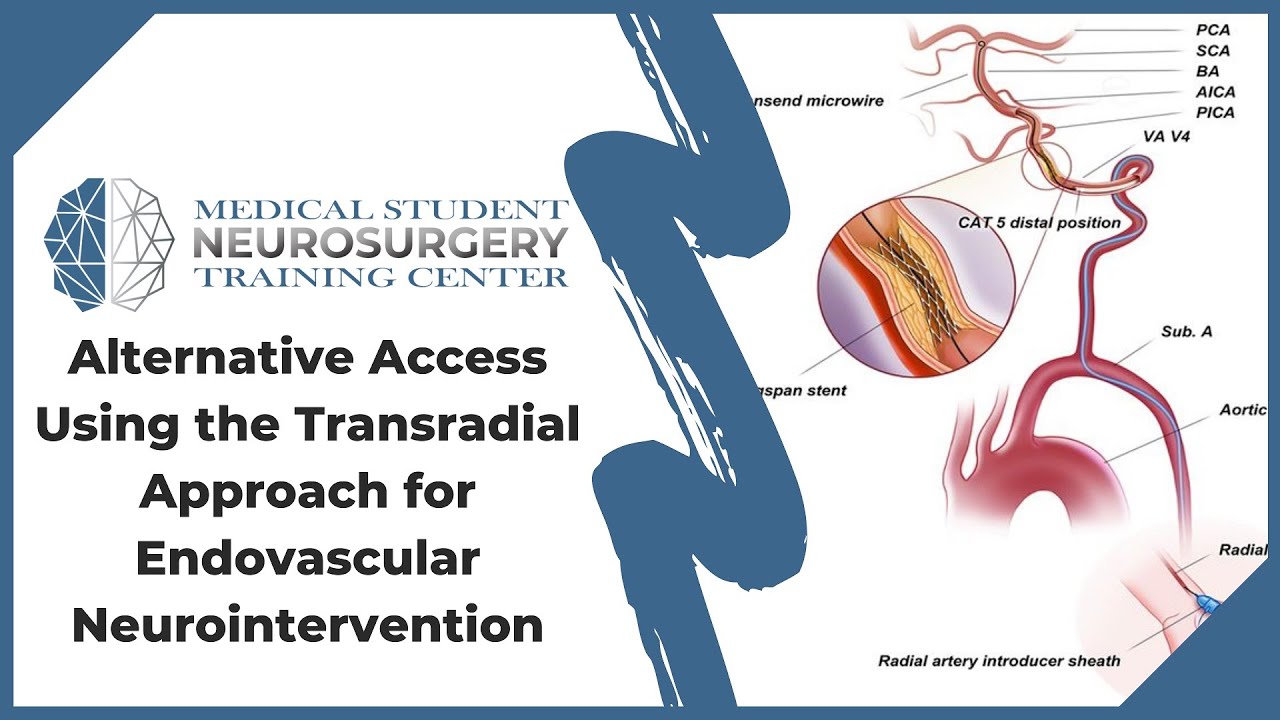 Alternative Access Using the Transradial Approach for Endovascular