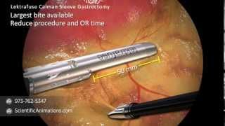 Sleeve Gastrectomy Procedure