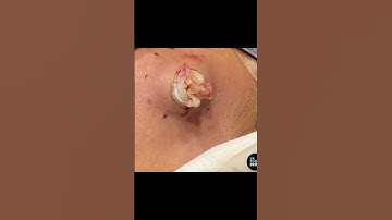 Tag a friend who is need of a cyst extraction today... or a friend who likes hermit crabs...