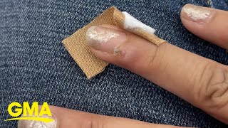 Woman claims she got HPVrelated nail cancer after salon visit l GMA