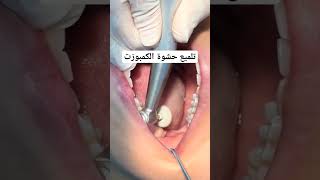 finshing & polshing composite after restoration||تلميع الضروس بعد حشو الكمبوزيت