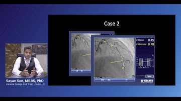 Case review: iFR Co-registration and virtual stenting with Dr. Sayan Sen
