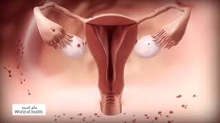 هذه أبرز أسباب التهاب بطانة الرحم عند المرأة