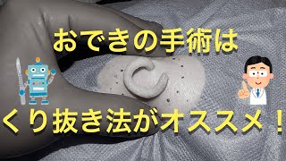 【音声あり】おでき（粉瘤）は中身をしぼり出して袋をひっぱりだす「くり抜き法」がオススメ！