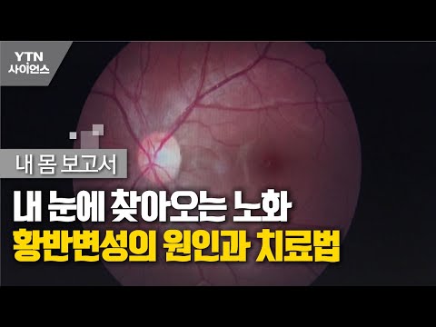   내몸보고서 내 눈에 찾아오는 노화 황반변성의 원인과 치료법 YTN 사이언스