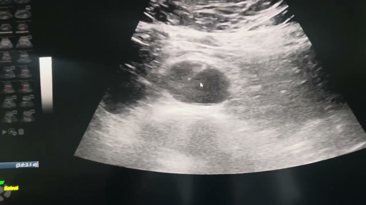 Bóc tách động mạch chủ trên siêu âm doppler 