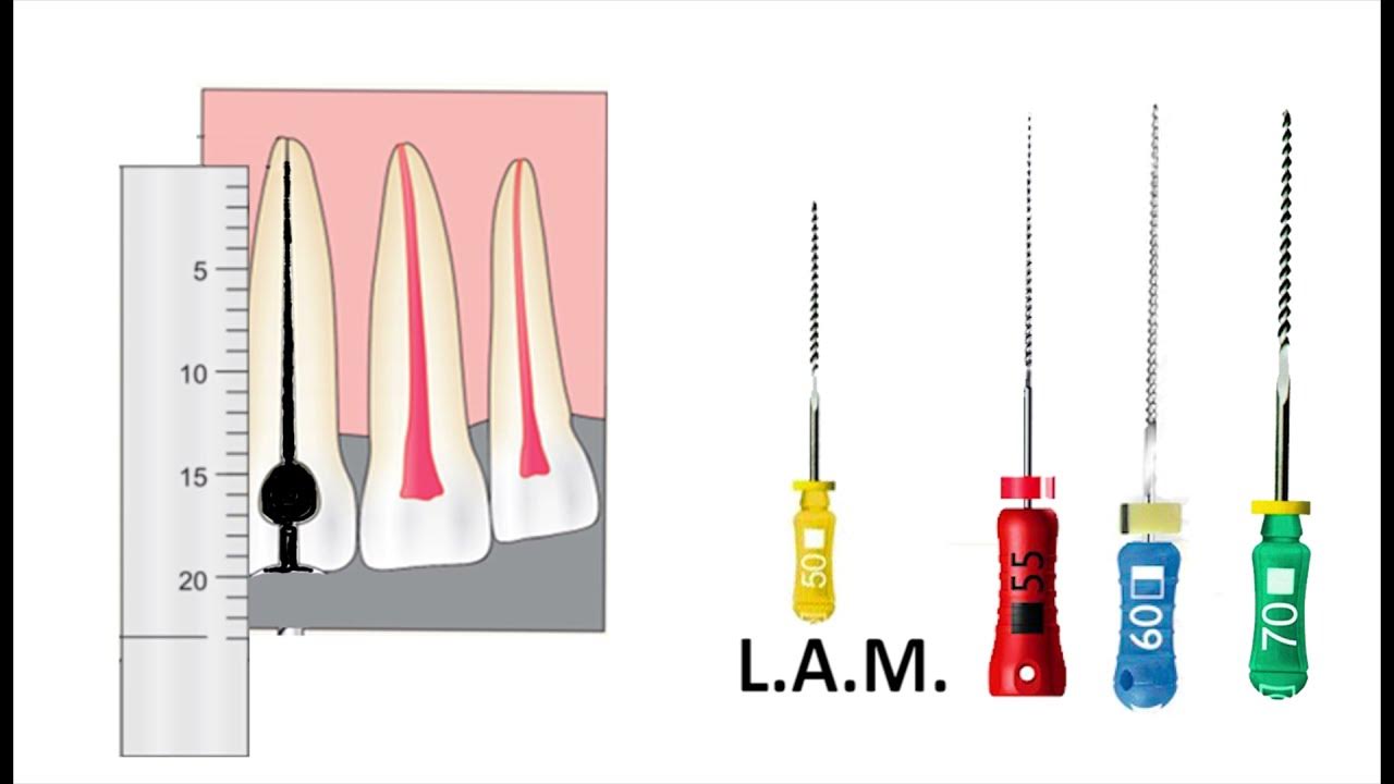 Técnicas De Instrumentación En Endodoncia Pdf www.youtube.com