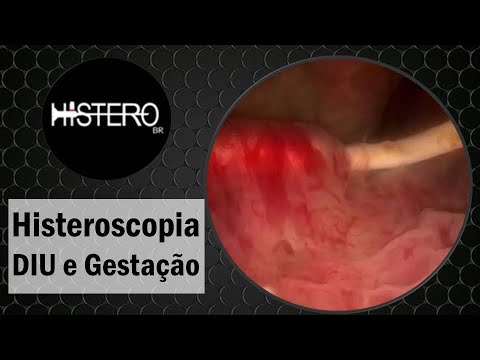 Vídeo: Grávida De DIU: Sintomas, Complicações, Interrupção E Muito Mais