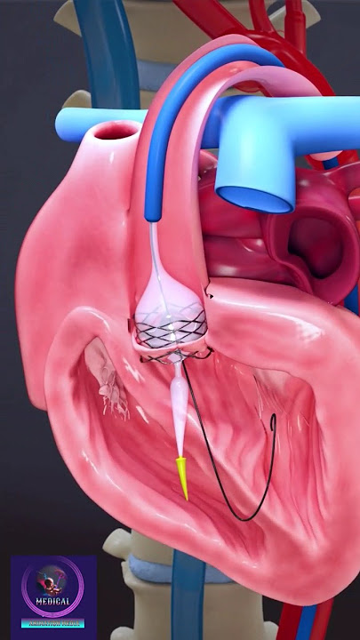 Heart Stent, Aortic Valve Repair with angioplasty #shorts #heartstent