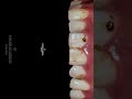 Before and after a full set of veneers, #veneers #koreadentist