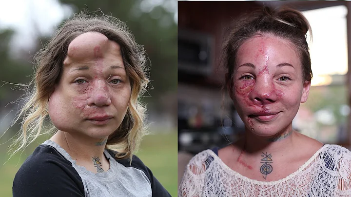 Mum Has Medical Balloons Removed From Her Face