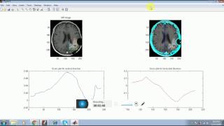 vertulonix  A Patch Based Approach for the Segmentation of