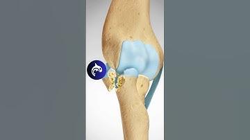 See how a Radial Head Fracture of the Elbow is fixed - 3D Animation