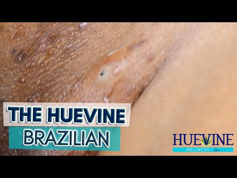 The HueVine Brazilian Skincare Updated Commentary | HueVine Ingrown Hair