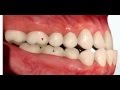 Class III Malocclusion