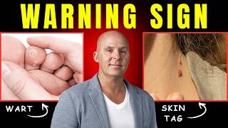 Skin Tags & Warts Are a Warning Sign (Here’s What’s Going On)