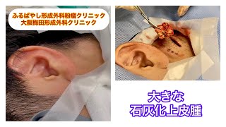 大きな石灰化上皮腫　ふるばやし形成外科粉瘤クリニック東京新宿院　大阪梅田形成外科クリニック　粉瘤と同様に炎症を起こすので早めの摘出が大事になります。エコーですぐに診断できます。