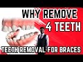 Why remove teeth before braces/Teeth removal and braces/ how many teeth to remove before braces