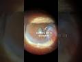 Pterygium+Cataract#eyehospital #eyes #eyecare #viral #optometry #cataract #answer #opthalmologist