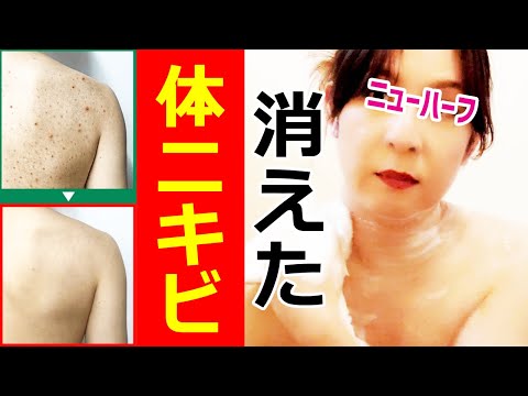 何使っても体ニキビが治らない人へ（顎下・デコルテ・首後ろ・背中ニキビ）ボディシャンプー