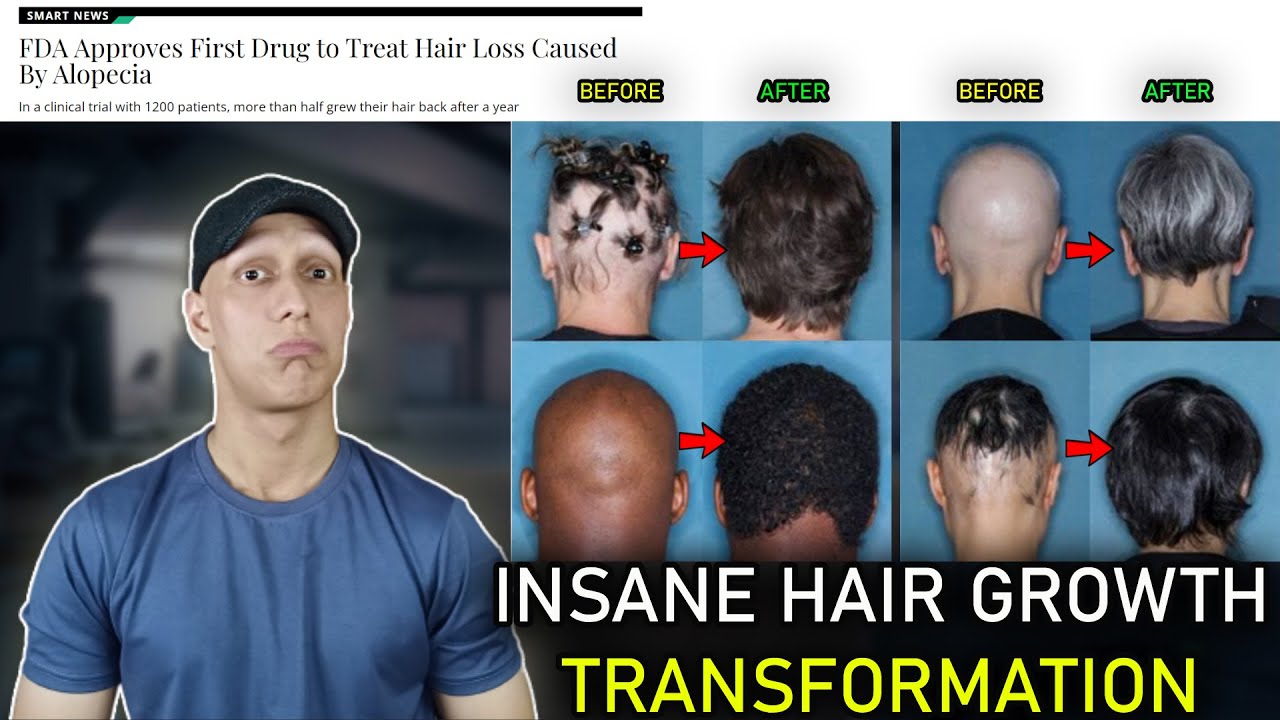 FDA approves First Treatment for Hair Loss (Alopecia Areata) - My Thoughts  - thptnganamst.edu.vn