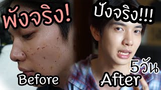 แก้หน้าพัง เป็นหน้าปัง ใน 5 วัน!!! | Zellfie