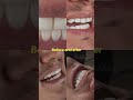 Cali Aesthetic Traveler LLL ❤️ceramic veneers