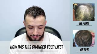 STEM CELL Hair Restoration  for Hair Loss with before and after photos
