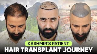 Hair Transplant In Mumbai hxfgrd  Best Results U0026 Cost Of Hair Transplant In Mumbai