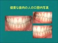 新しい歯周病治療-歯周内科治療（内科的歯周病治療）