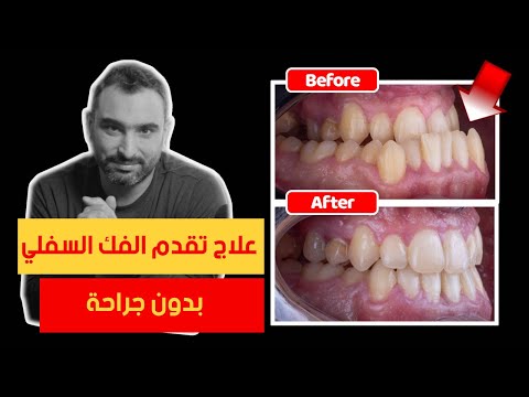 فيديو: 3 طرق لفك الأسنان
