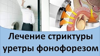 Лечение стриктуры уретры фонофорезом