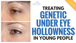 The Cause of Under Eye Hollowness in Young People, and How it Can be Treated
